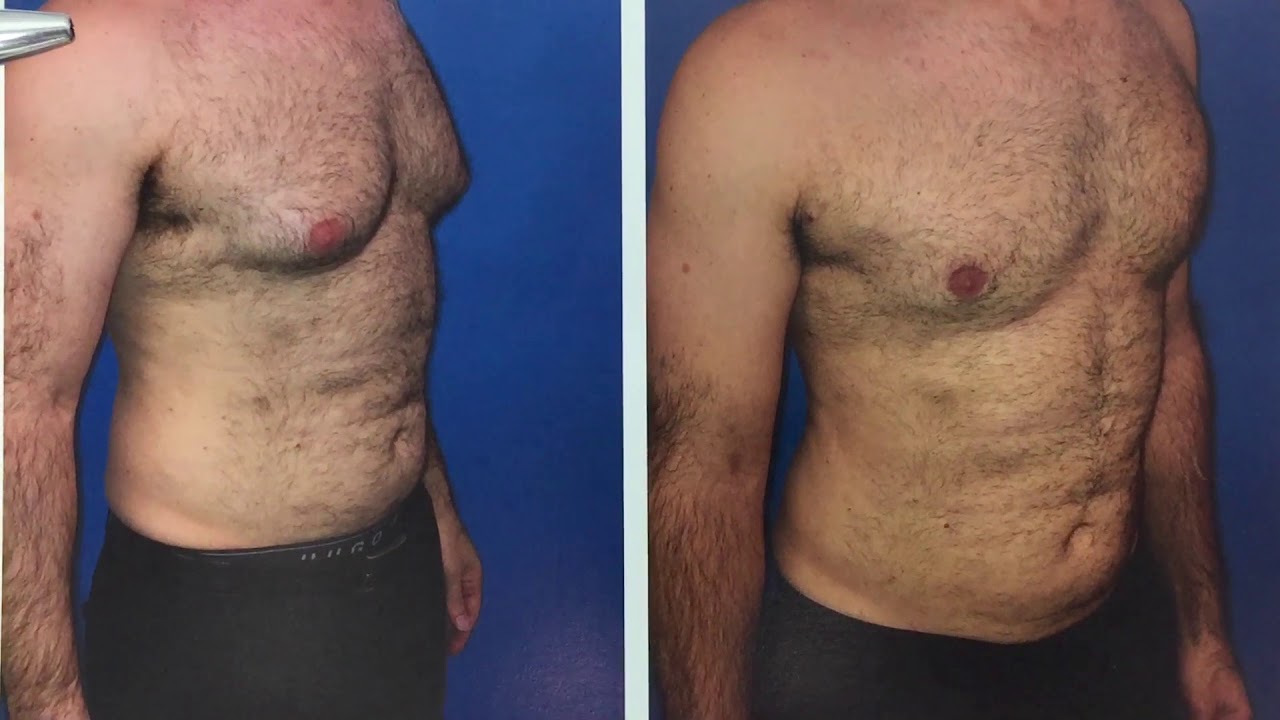 The Significance Of Best Gynecomastia Surgeon Near Me
